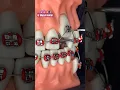 Pick the RED BRACES go on