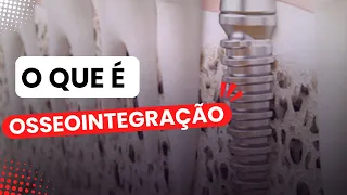 OSSEOINTEGRAÇÃO, A CICATRIZAÇÃO DO IMPLANTE