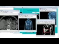 Liver Tumor Segmentation Matlab Code 3D Projects