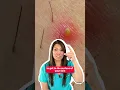 Do you struggle with ingrown hairs