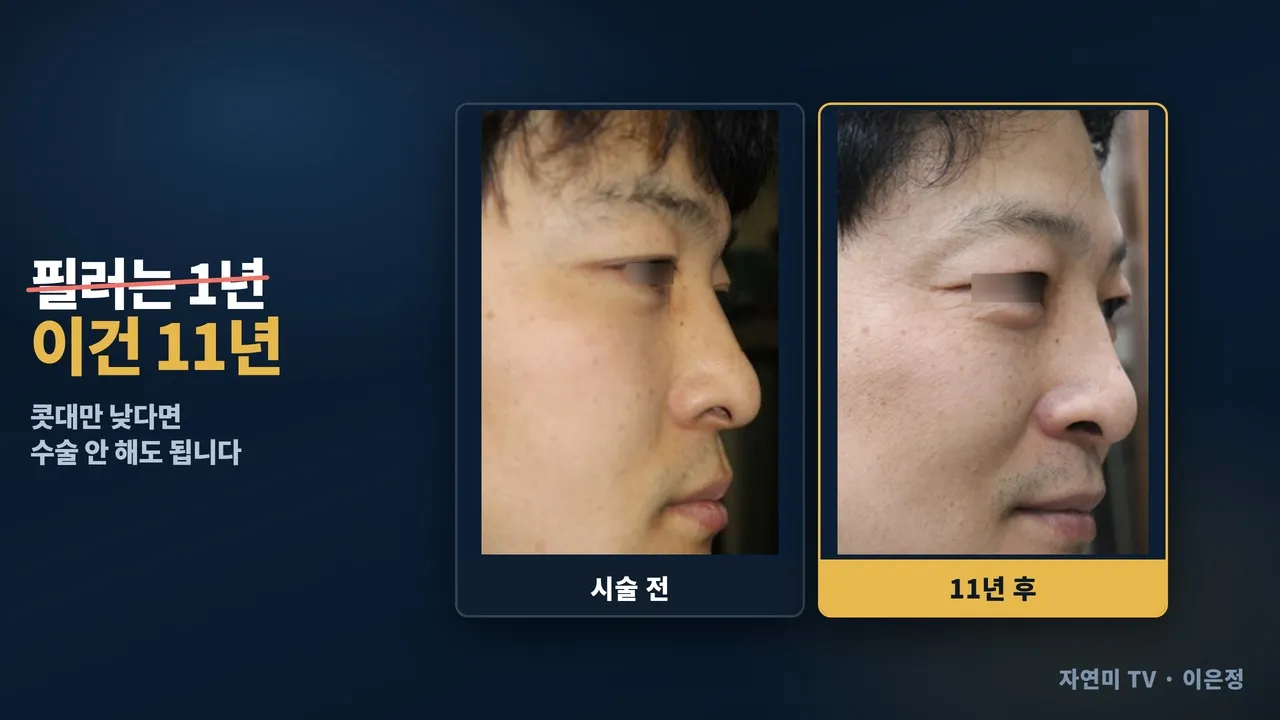 콧대만 낮다면 수술까지 하지 마세요 | 필러·보형물·자가조직 부스터 11년 추적#아테콜#콧대필러 #코필러 #코성형 #PMMA필러 #아테센스#복코 #복코수술 #콧볼축소