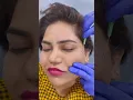 Download Lagu Improving and lifting the smile lines using COG THREADS | Dermalyn Aesthetics | CALL : 9311691081 |