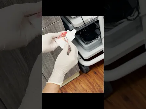 Why This Pilar Cyst Looks Like Egg Noodles