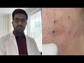 Pimple Popping Part 3 Extremely Satisfying