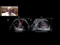 Low Velocity Blood Flow Detection DFI in Fetal Medicine - Clinical Cases with Dr Marc Althuser