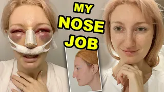MY NOSE JOB PART 1 RHINOPLASTY SEPTOPLASTY SURGERY RECOVERY 2020