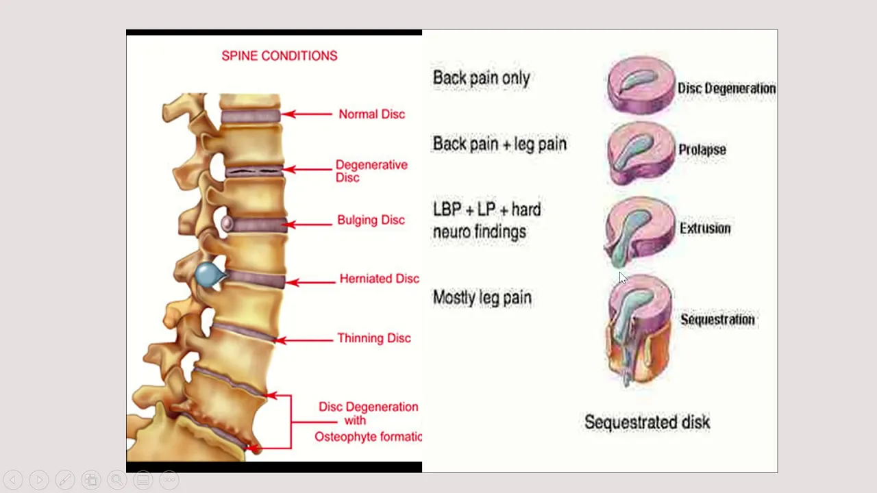 SCIATICA - SARAF TERJEPIT. 