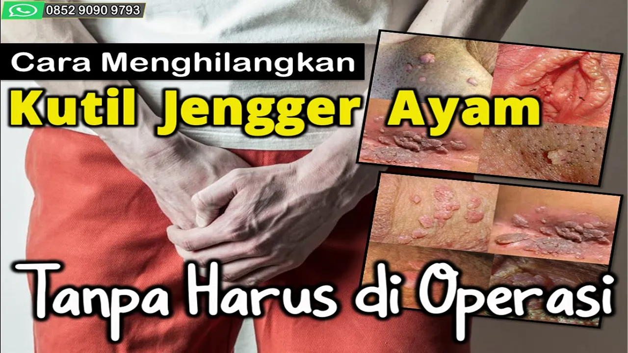 Cara Mengobati Kutil Kelamin: (Penyakit Jengger Ayam)