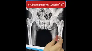  ทำไมคนไข้ที่เป็นมะเร็งต่อมลูกหมากถึงมีอาการปวดขาและเข่า 