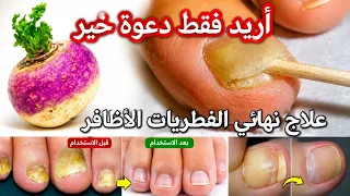 بخضرة واحدة علاج فطريات الأظافر والكزيما للأبد /وصفة تغنيك عن طبيب/ #مجربة /أريد فقط دعوة خير