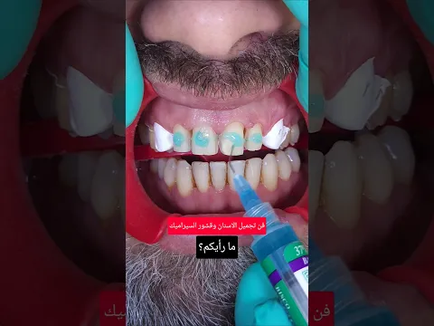 فن تجميل الاسنان وقشور السيراميك
