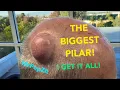 Gigantic Pilar Cyst Don t miss this one it has it all Unique secondary encapsulated lining