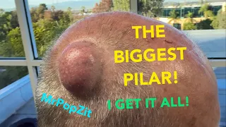Gigantic Pilar Cyst! Don’t miss this one, it has it all! Unique secondary encapsulated lining. 