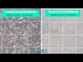 Oligozoospermia - Low Sperm Count Comparison of Normal Semen Sample with sample with Low Count
