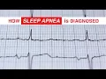 How Sleep Apnea is Diagnosed