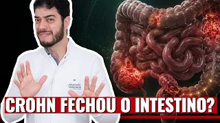 Doença de Crohn Pode Causar Estenose Intestinal? Entenda Quando Precisa de Cirurgia