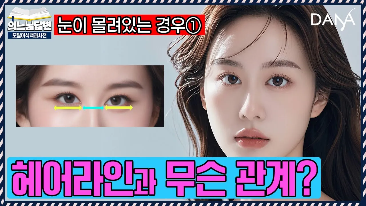 의느님답변📂헤어라인 교정으로 눈 몰림 해결될까?ㅣ눈이 모여있는 경우의 해결 방법①ㅣ다나성형외과(DANA)ㅣ모발이식ㅣ헤어라인교정ㅣ두피문신ㅣ탈모치료