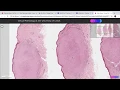 Virtual microscopy - Neurofibroma