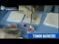 Tumor Markers and EBUS