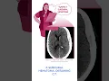 Diagnostics on Demand: Subdural hematoma