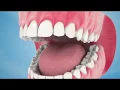 Lagu Dental Implant Procedure