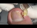 Download Lagu Deep nail cleaning
