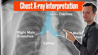 Download Chest X ray interpretation (in 10 minutes) for beginners🔥🔥🔥 #chestxray #cxr MP3