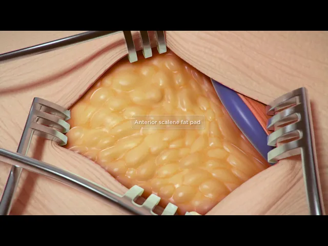 Thoracic Outlet Syndrome