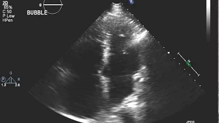 Echocardiogram with Bubble Study Extracardiac Shunt