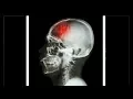 Stroke Risk Factors