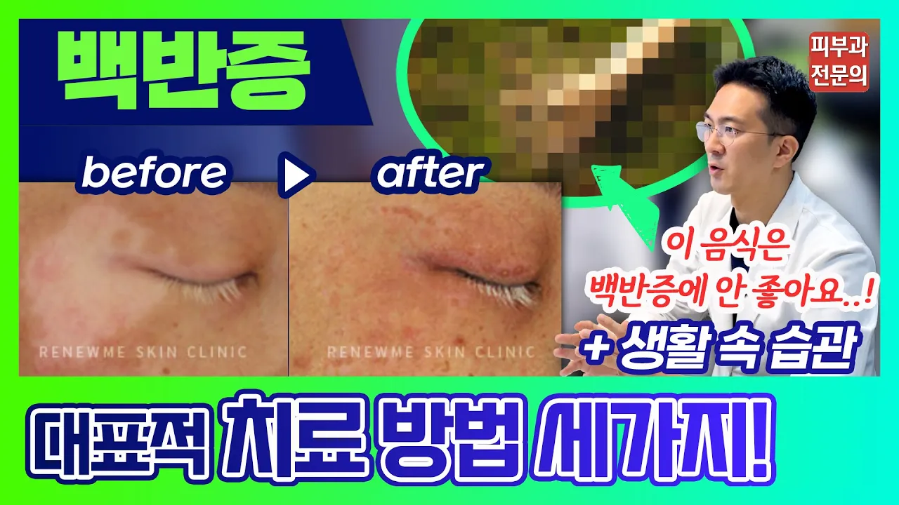 '백반증' 팩트 체크! [치료방법∙헷갈리는 질환∙생활습관∙나쁜 음식∙보험 등]