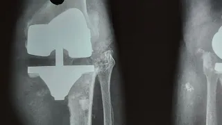 TKA X-Ray What To See And How To Interpret