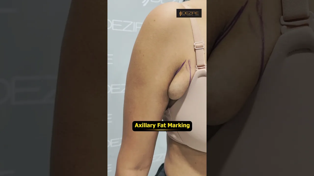Axillary Fat marking