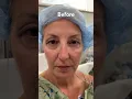 Upper Blepharoplasty Eyelid Lift Before and Immediately After