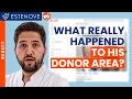 Doctor Reacts to Reddit Hair Transplant Cases