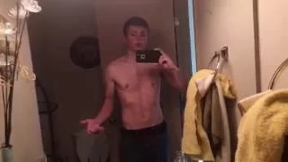 Pectus Excavatum Surgery Pre Op Nuss Procedure Part 1 