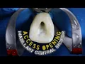Access Opening of Maxillary Central Incisor step by step demonstration