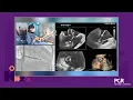 Tailoring tricuspid interventions with the EVOQUE and PASCAL Precision systems - PCR London Valves