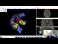 Anatomy of the limbic system using 3D reconstructed MR data