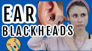 how to get rid of blackheads in the ear dr dray
