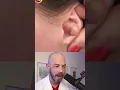 Download Lagu Derm reacts to pimple-popping compilation! #dermreacts #doctorreacts #pimplepop