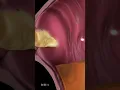 Download Lagu What Is Acid Reflux (Animation)