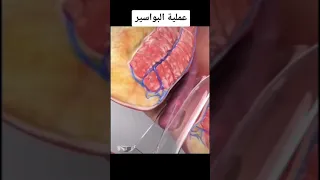 عملية البواسير 