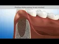 Download Lagu Extracted tooth without ridge preservation