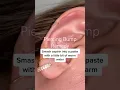 How to get rid of Piercing Bumps