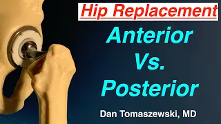 anterior vs posterior hip replacement