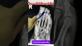 นิ้วหัวแม่เท้าบิดงอและมีก้อนนูนขึ้นมา สาเหตุคืออะไร และรักษาอย่างไร