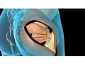 Total Hip Replacement