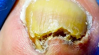 There Is A Nail At The Front Of The Toenail, Very Deep!【Xue Yidao】