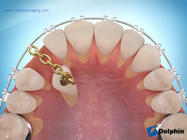 Impacted Cuspid with Palatal Treatment